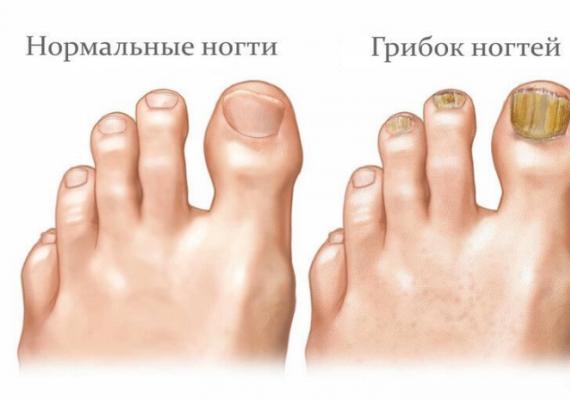 Лечение грибка ногтей народными средствами – самые эффективные и безопасные методы