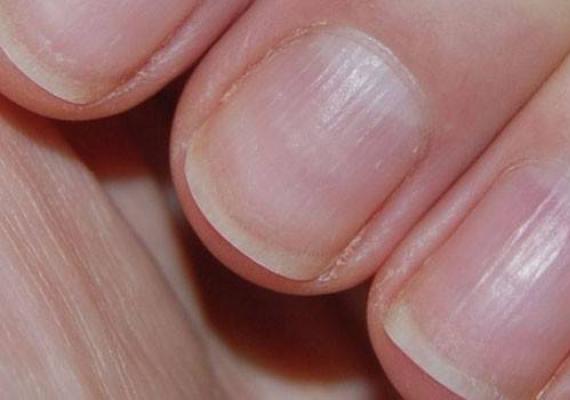 Почему ногти растут волнами: описание с фото, возможные причины и методы решения проблемы Отчего волнистые ногти