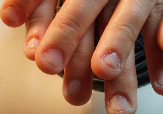 Болезни ногтей на руках и их лечение