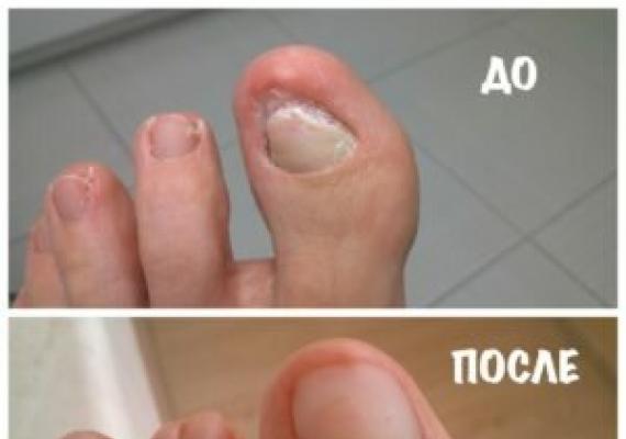 Болезни и проблемы ногтей